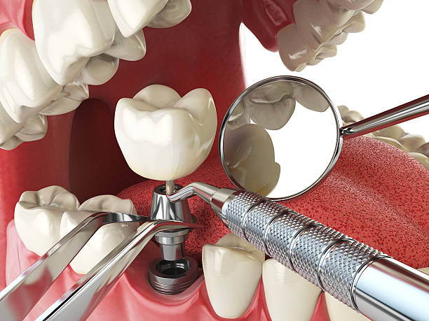 Best Emergency Treatment for Dental Infections or Abscesses in Manchester, PA